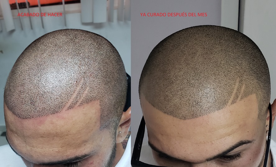 Resultado de la micropigmentación capilar al mes de realizada en el Estudio Yasmany Tattoo. La Habana