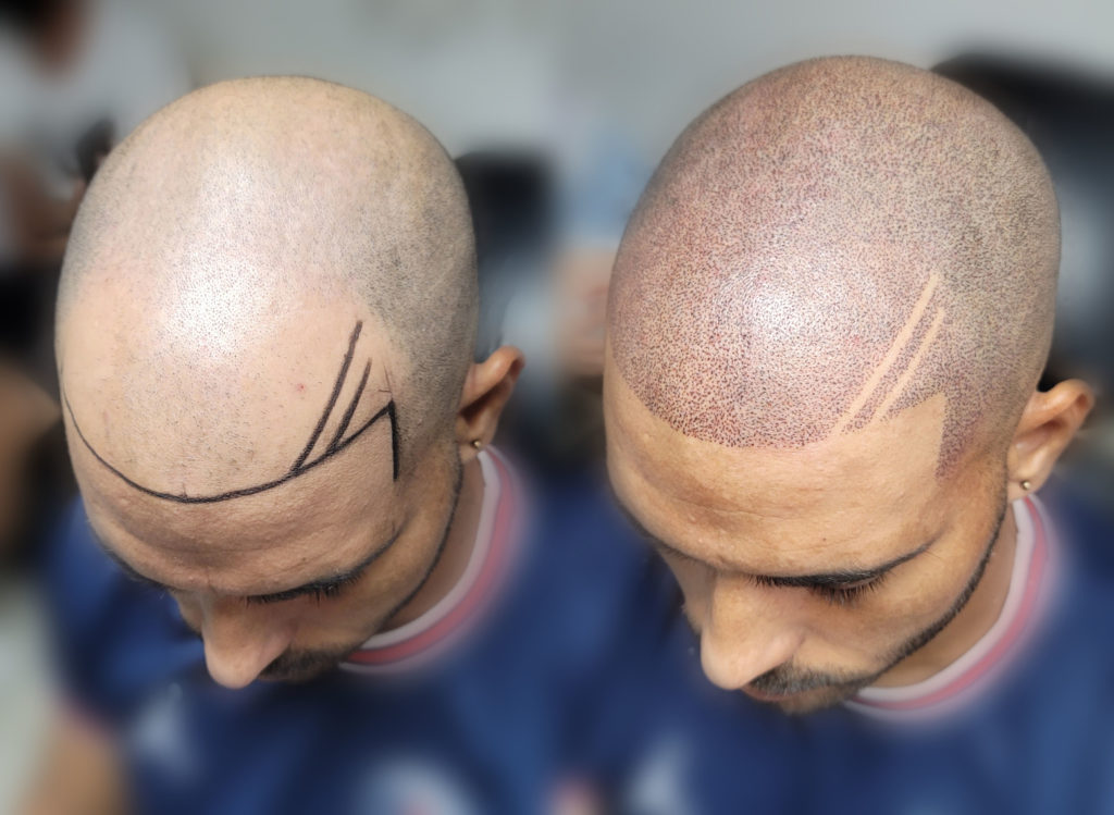 Tattooed Scalp Micropigmentation in Tampa Bay