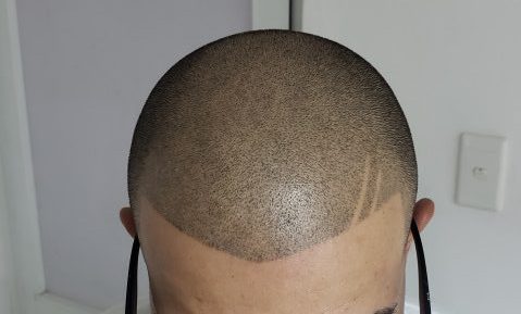 Scalp Micropigmentation in Tampa Bay